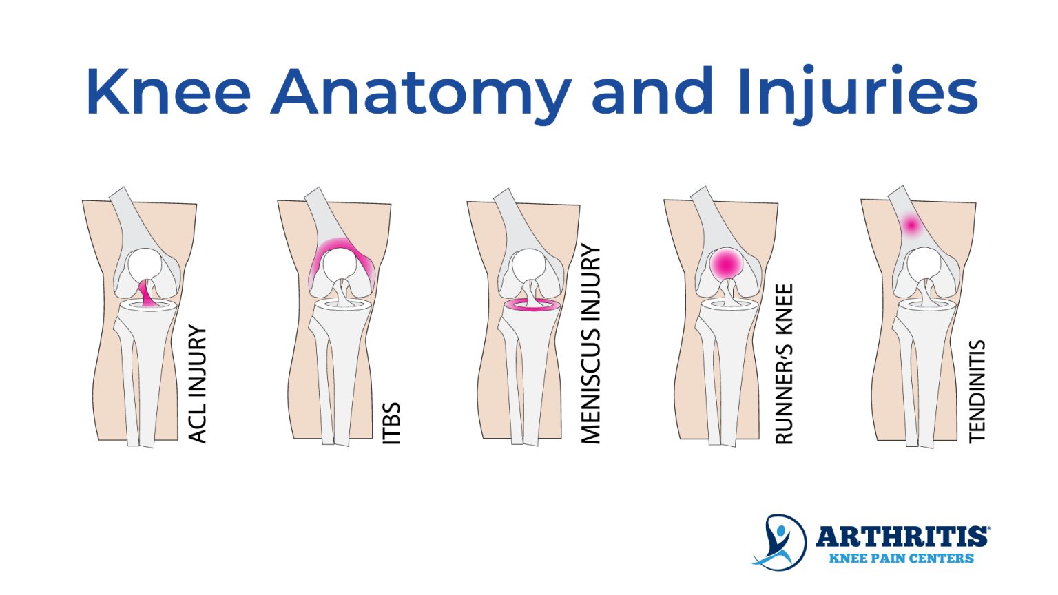 Knee Pain Location Chart Arthritis Knee Pain Centers   Knee Anatomy And Injuries 1536x864 