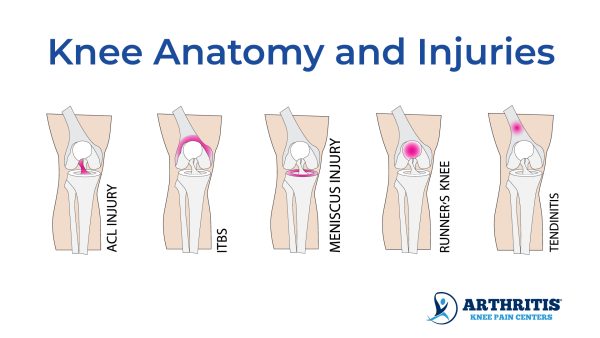 Knee Pain Location Chart | Arthritis Knee Pain Centers