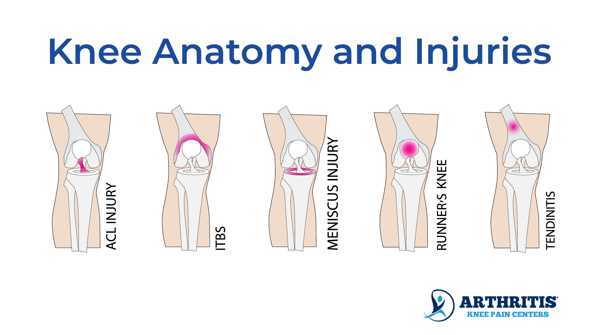 Inner Knee Pain: Why Does the Inside of My Knee Hurt?