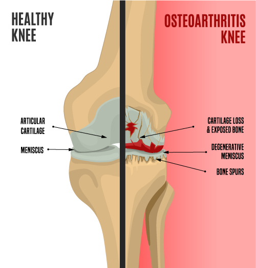 healthy knee vs oa knee
