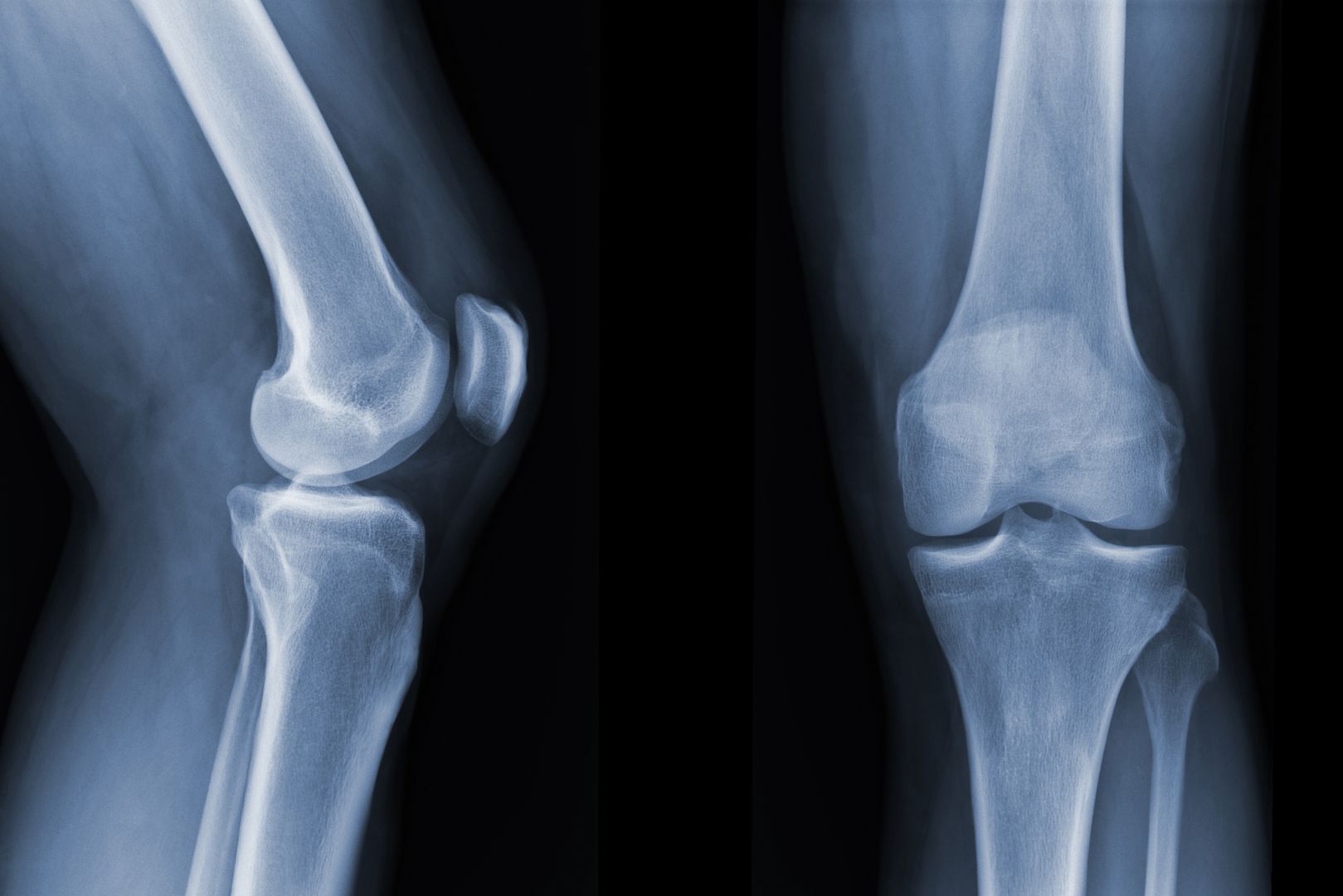 Image showing a knee x-ray from the side and front.