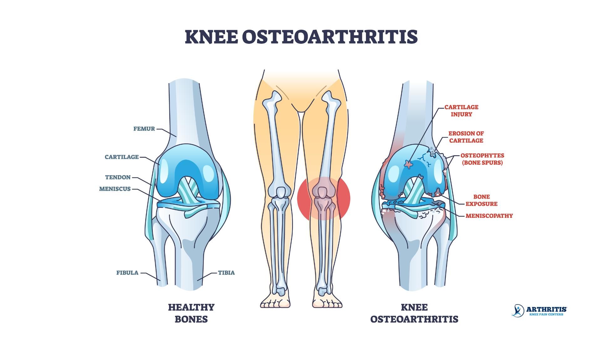 bone spurs and osteoarthritis diagram