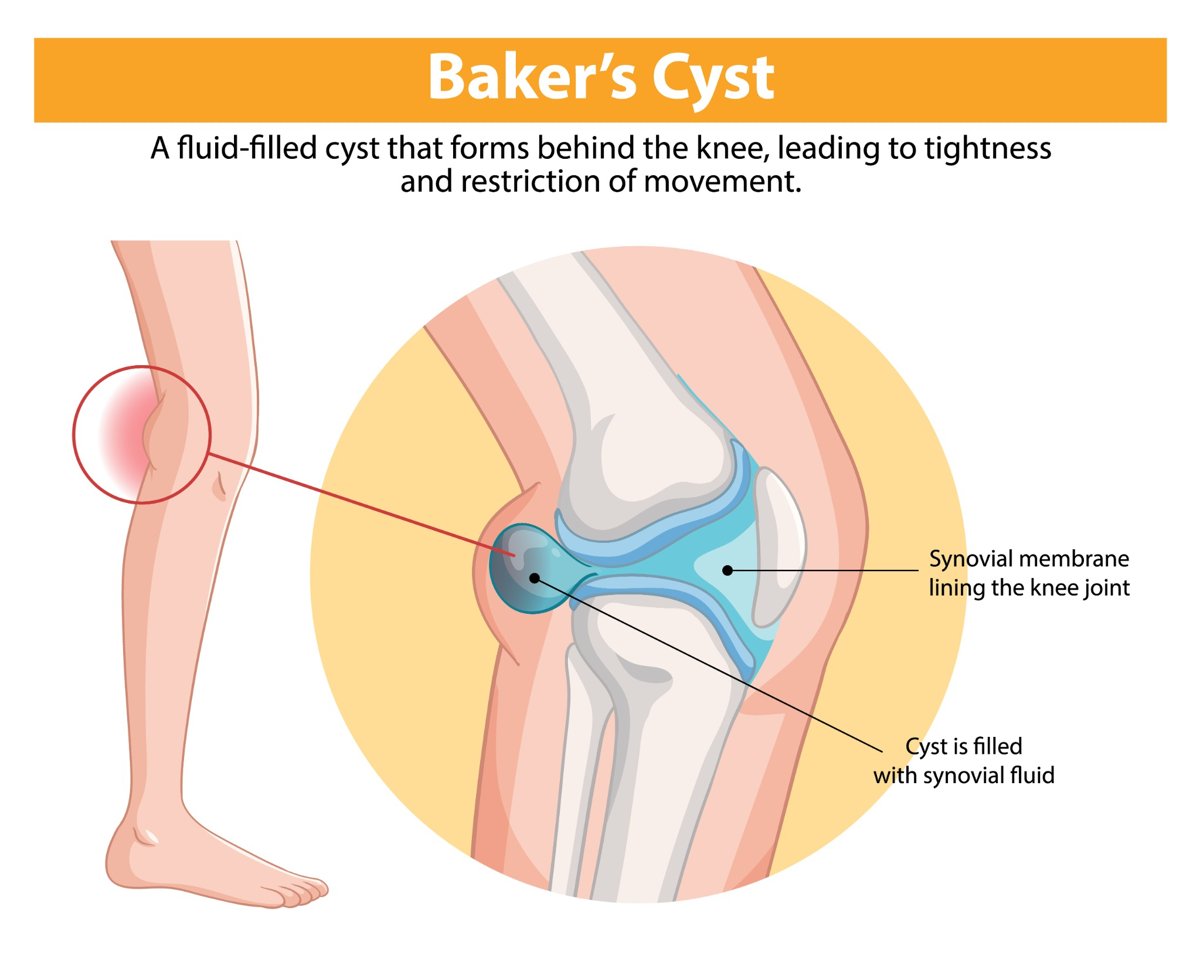Medical illustration diagram showing a Baker’s or popliteal cyst behind the knee filled with synovial fluid, leading to discomfort and restricted movement.